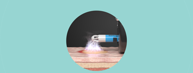 Close-up of the unique FiAPC® plus circumferential probe tip, which delivers a complete 360° flow of argon gas, preventing direct tissue contact.