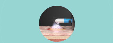 Close-up of the FiAPC® plus sidefire probe tip, specialized for the targeted treatment of lateral lesions.